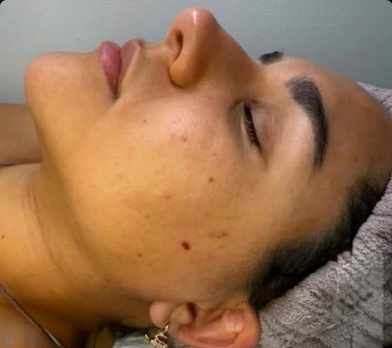 Piel antes del Advanced Purifying & Detox Facial